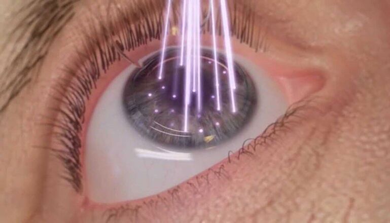 Chirurgie des yeux au laser